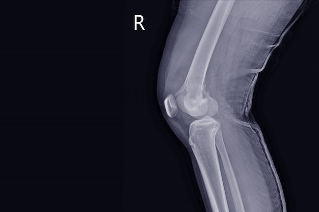 X-ray Knee join a female Showing large osteolytic lesuion of medial aspect of right distal femur.