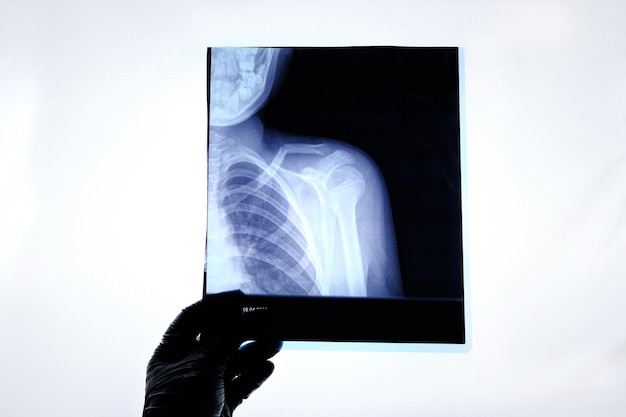 Xray image of a man with a broken collarbone