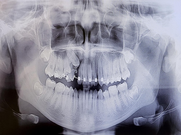 Xray image of teenage teeth Correction of bite and tooth extension