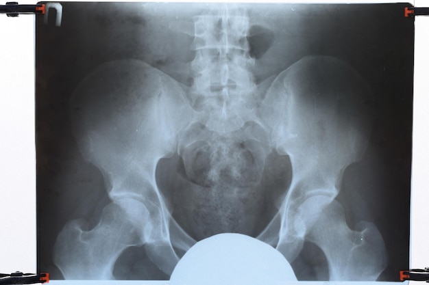 Photo xray of the pelvis and sacrum xray