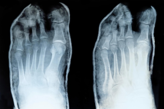 Xray of toes with displaced little finger