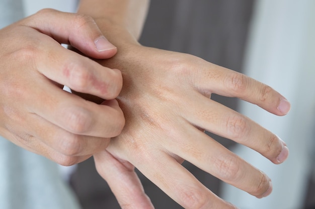 Photo young asian man itching and scratching on hand from itchy dry skin eczema dermatitis