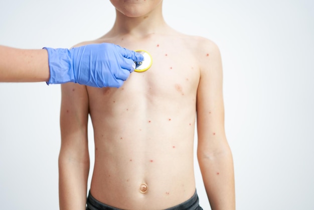 Young boy having chickenpox pictures of skin