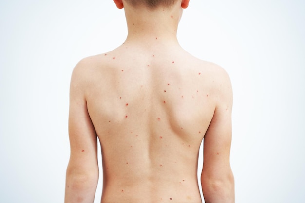 Young boy having chickenpox pictures of skin