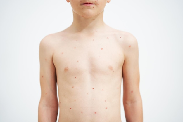 Young boy having chickenpox pictures of skin