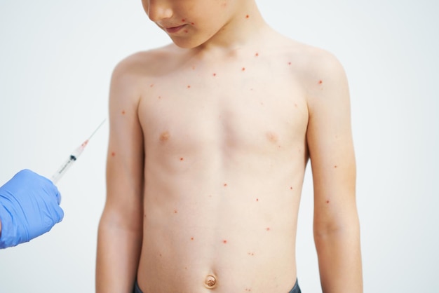 Young boy having chickenpox pictures of skin