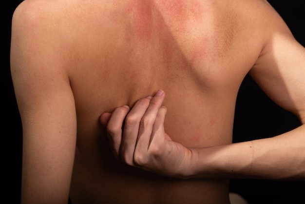 Young man shirtless scratching his back with his hands Skin disease Irritation allergy