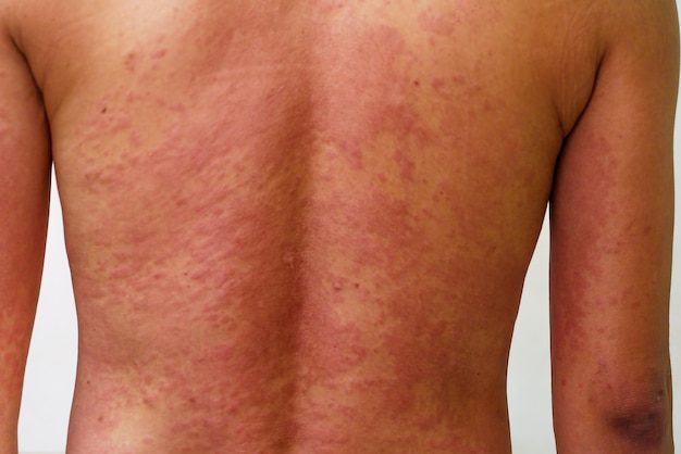 Young man with rash from the drug allergy