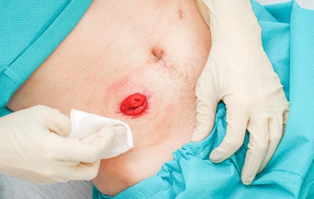 A young patient in pajamas and sterile gloves cleans the intestines on his stomach with a napkin