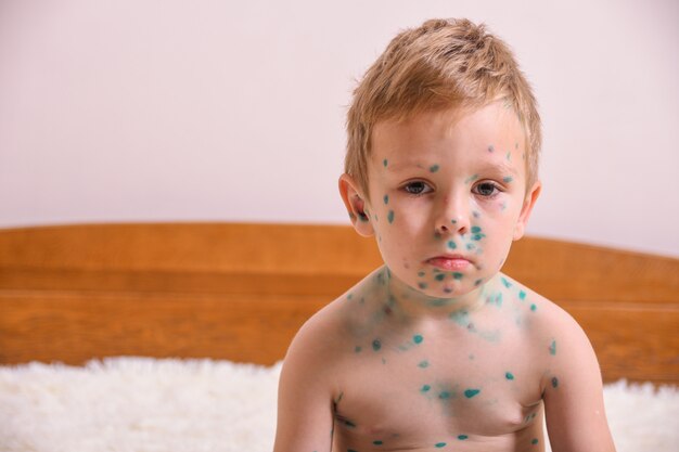 Photo young toddler,boy with chickenpox. sick child with chickenpox. varicella virus or chickenpox bubble rash on child body and face.