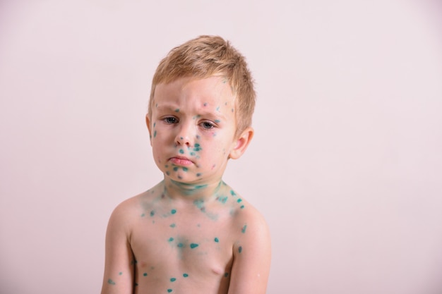 Photo young toddler, boy with chickenpox. sick child with chickenpox. varicella virus or chickenpox bubble rash on child body and face. 