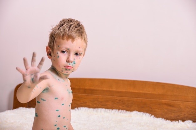 Photo young toddler,boy with chickenpox. sick child with chickenpox. varicella virus or chickenpox bubble rash on child body and face.