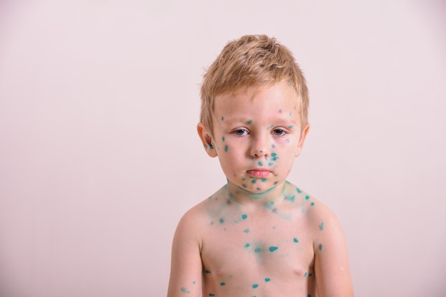 Young toddler,boy with chickenpox. Sick child with chickenpox. Varicella virus or Chickenpox bubble rash on child body and face.