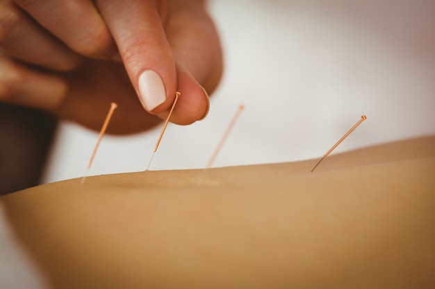 Young woman getting acupuncture treatment