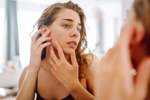 Young woman looks in mirror examining inflammation on her face Acne skin Medicine and cosmetology