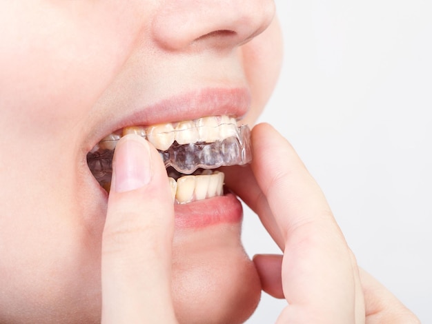 Young woman puts transparent aligner