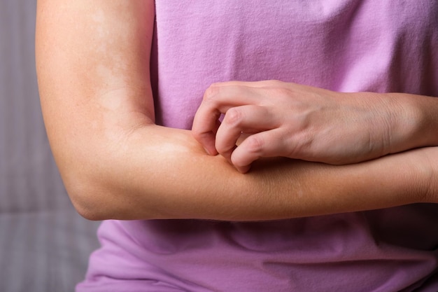 Photo young woman scratches her hands from itching. allergic dermatitis. skin disease vitiligo. neurodermatitis disease, eczema or allergy rash. healthcare and medical..