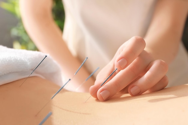 Young woman undergoing acupuncture treatment closeup