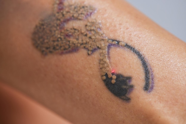 Young woman undergoing laser tattoo removal procedure in salon closeup