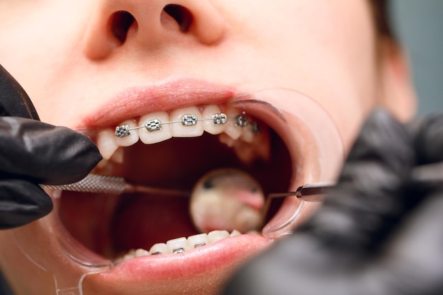 A young woman with metal braces is being examined by an orthodontist correction of the bite of teeth