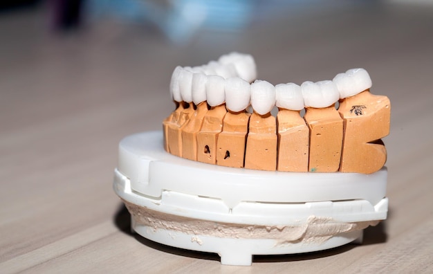 Zirconium Porcelain Tooth plate in Dentist Store Photo