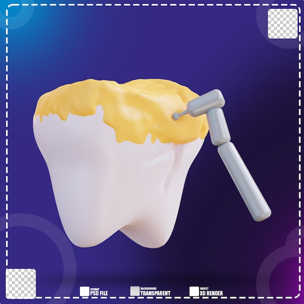 3d illustration of cleaning tooth decay with a drill 3