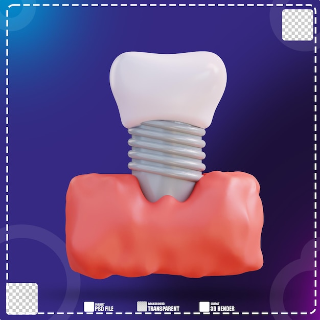 3d illustration of fitting dentures 2