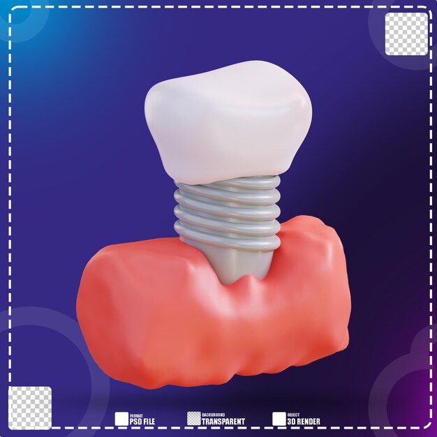 3d illustration of fitting dentures 3