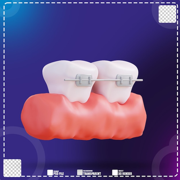 3d illustration of wearing braces 3