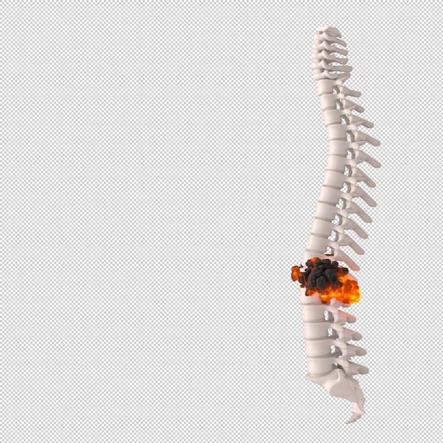 PSD human spine with disc herniation concept