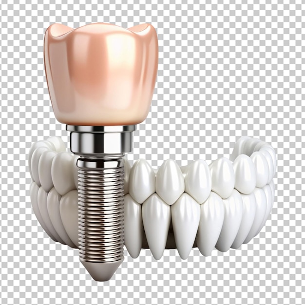 isolated set of white teeth and dental implant on transparent background