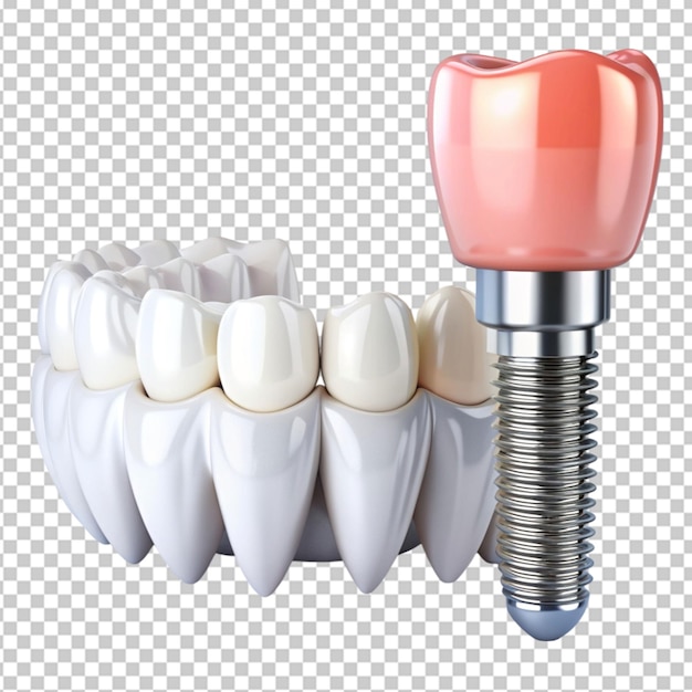 isolated set of white teeth and dental implant on transparent background