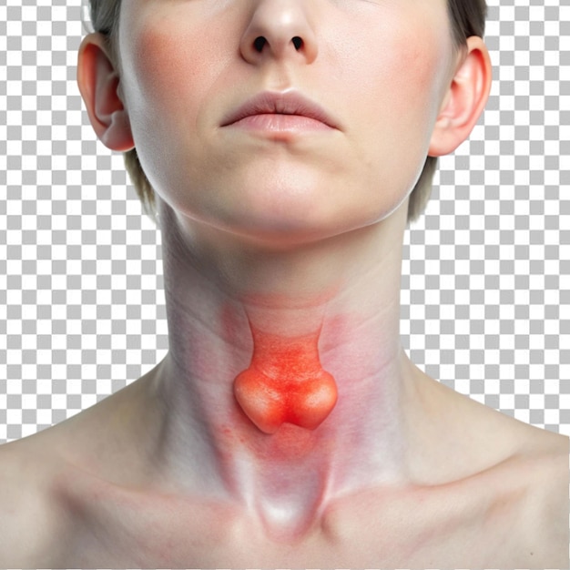 PSD picture of swollen thyroid