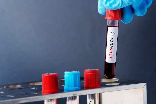 PSD surgeon holding a blood test tube mockup