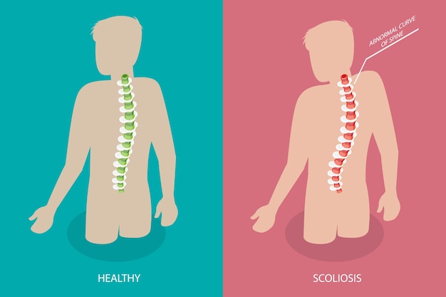 3D Isometric Flat Vector Conceptual Illustration of Scoliosis