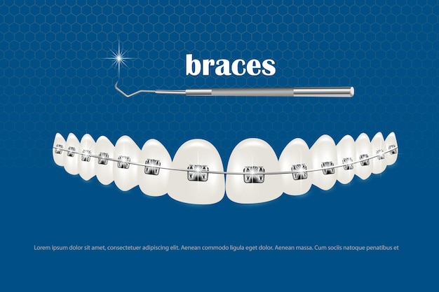 3d vector illustration realistic teeth with braces Alignment of the bite of teeth dentition with braces dental braces