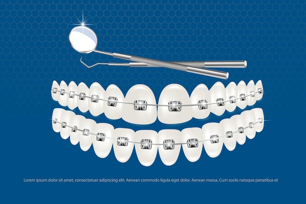 3d vector illustration realistic teeth with braces upper and lower jaw Alignment of the bite of teeth dentition with braces dental braces