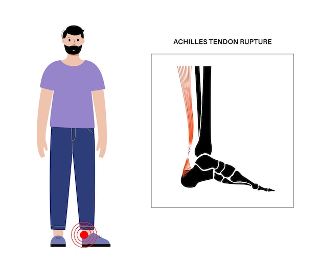 Vector achilles tendon rupture anatomical poster. ankle injury, ligament sprain, pain and tear problems