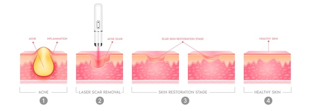 Vector acne scar vascular laser treatment inflammation associated with pimples the skin acne scar