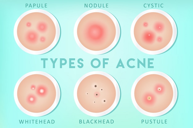 Acne types