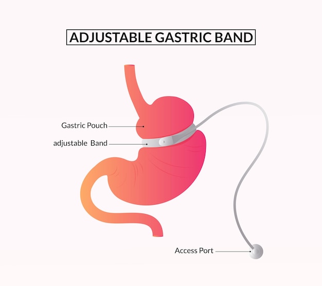 adjustable gastric band Lap Band Surgery Diagram Medical illustration