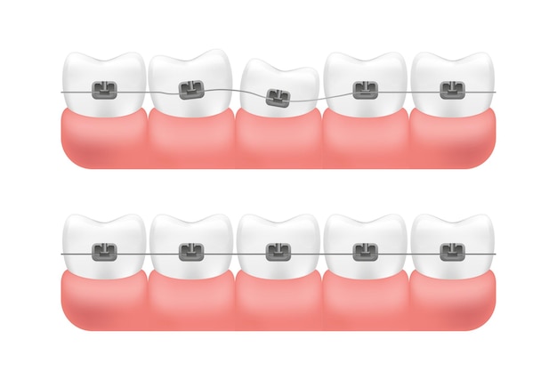 Vector alignment of teeth with braces system.