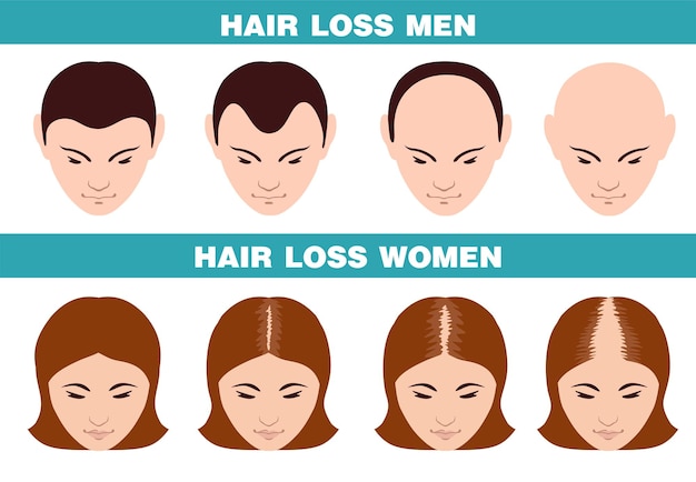 Alopecia stages set Hair loss stages Female and male alopecia Set of balding process Isolated