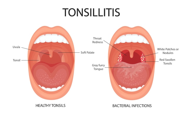 Angina pharyngitis and tonsillitis Tonsillitis is bacterial Tonsil infection Open mouth anatomy