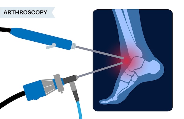 Vector ankle arthroscopy poster