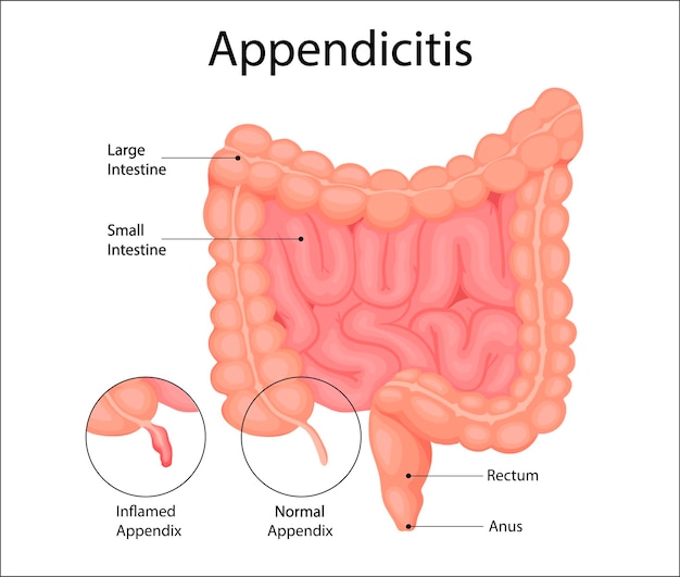 Appendicitis is an inflammation of the appendix Anatomical illustration