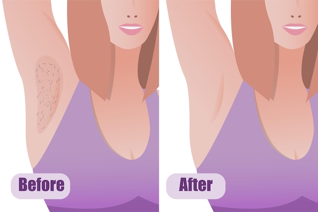 Armpit laser hair removal result before and after procedure girl body procedure beauty salon banner