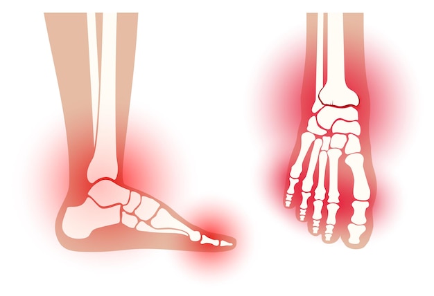 Arthritis foot joint. Rheumatoid pain in leg  flat vector illustration