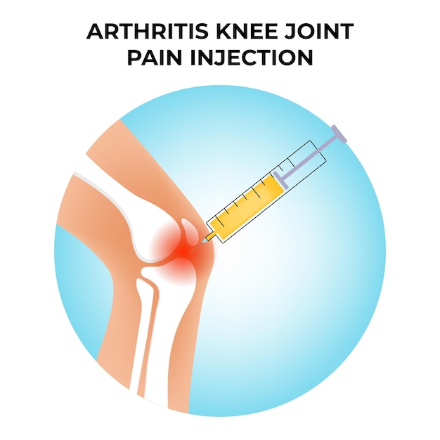 Vector arthritis knee joint pain injection vectorhuman bone anatomy flat vector illustration