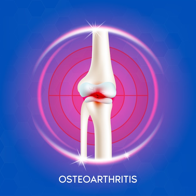 Arthritis knee joint. Pain in leg. Human bone anatomy.